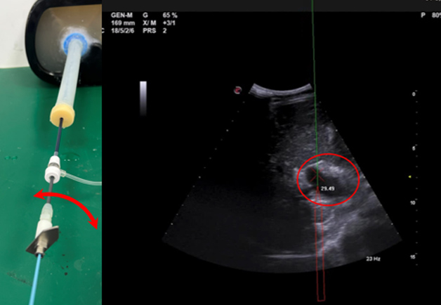 經(jīng)頸靜脈肝內(nèi)門體分流術（transjugular intrahepatic portosystemic shunt）